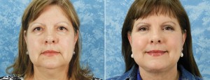 Face Lift & Lower Blepharoplasty                 